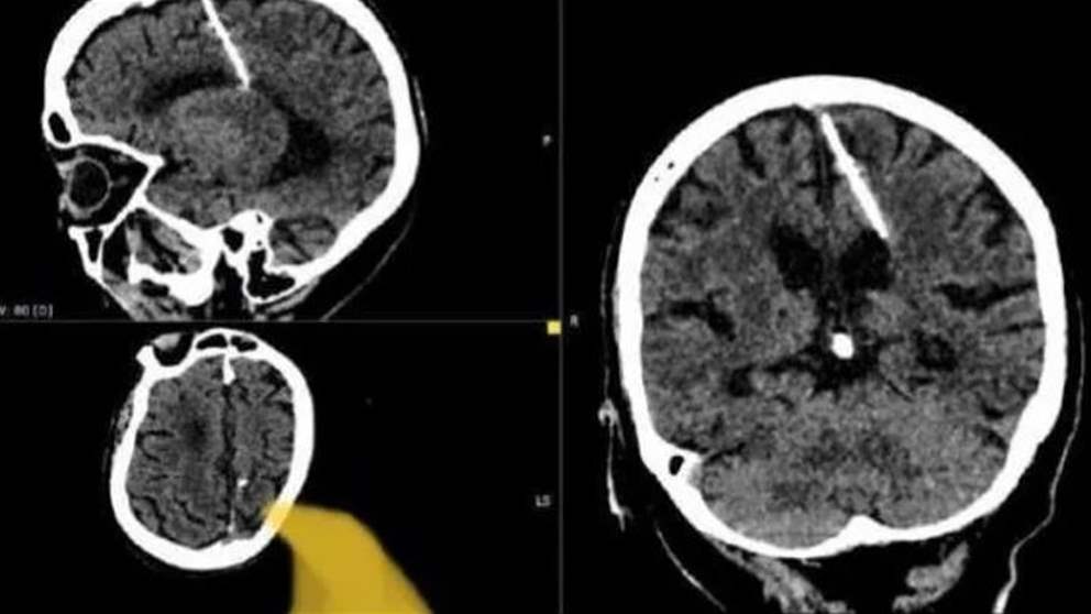 أطباء يعثرون على إبرة في دماغ امرأة منذ 80 عاماً
