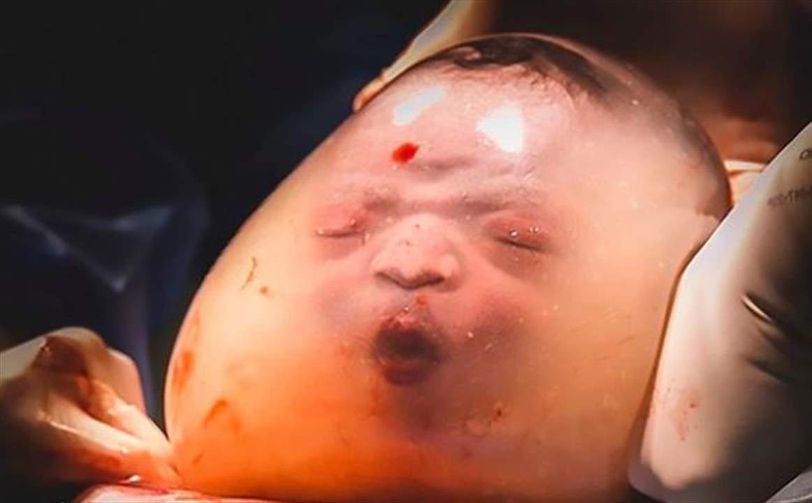 صور مذهلة لولادة يندر حدوثها في العالم!