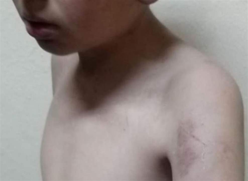 بالصور- طفل ضحية العنف الاسري... و"المعلومات" توقف الوالد 