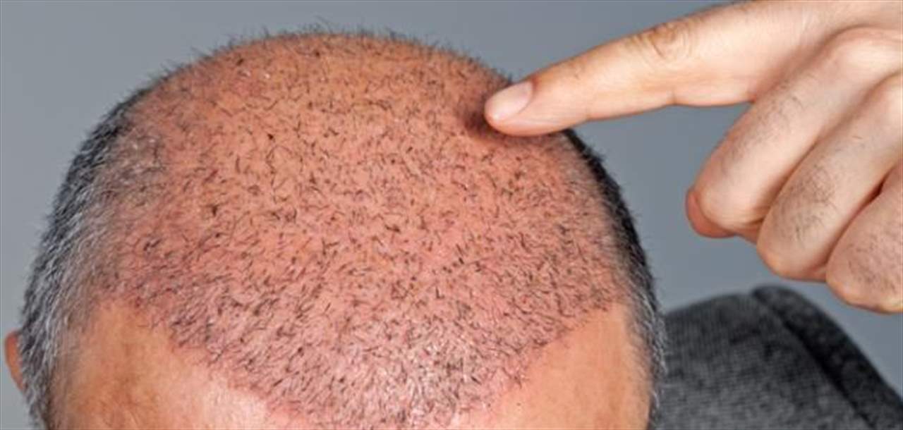 عملية زرع الشعر تودي بحياة رجل أربعيني!