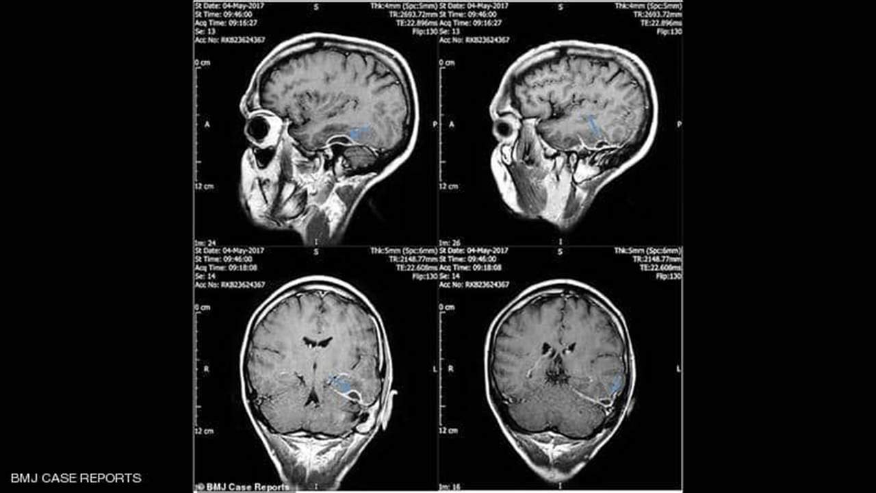  "عود القطن" يتسبب باصابة رجل بعدوى في جمجمته...  الالتهاب انتقل من الأذن إلى الخلايا!