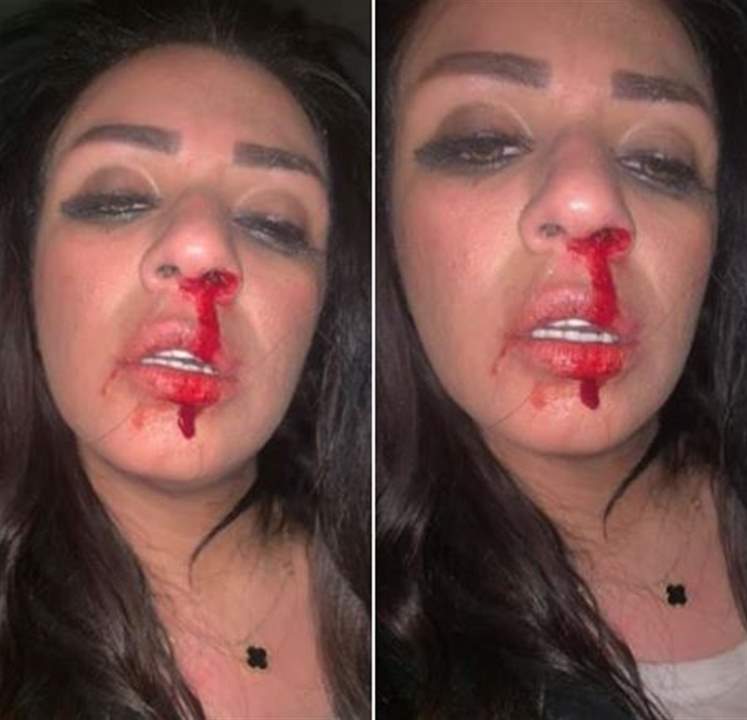فنانة ستار أكاديمي تنشر صورها بعد تعرضها للتعنيف الجسدي: زوجى ضربنى أنا وأمى