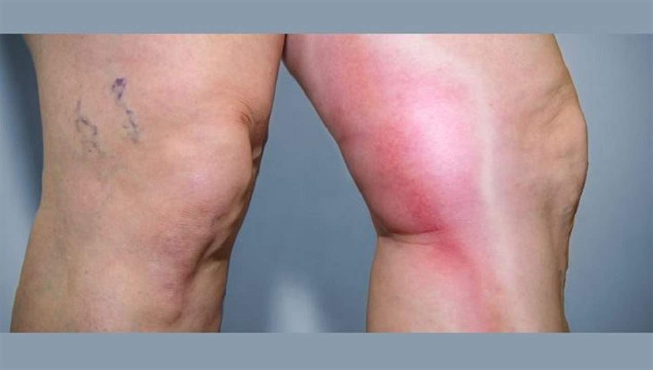 الجلطة قد تأتيكم من دون أن تلاحظوها.. إليكم أعراضها وأسبابها وسُبُل الوقاية!