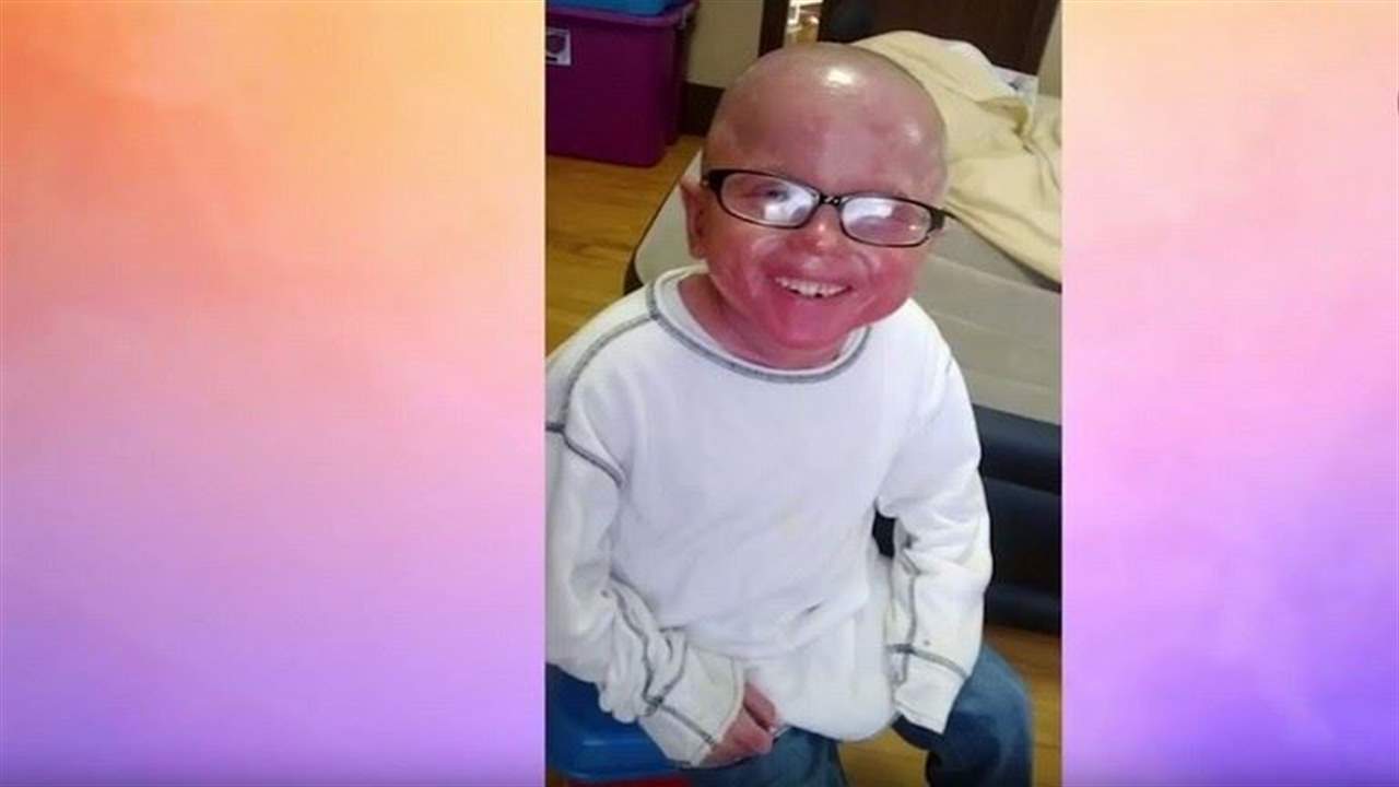 طفل يغيّر جلده كالأفعى... خالف جميع توقّعات الأطبّاء!