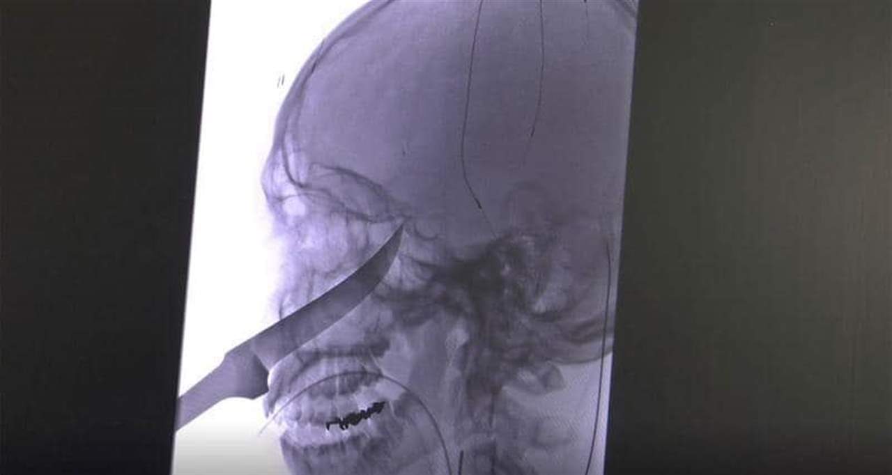 سكين بطول 25 سنتيمتراً اخترق جمجمته... كيف نجا إيلي؟