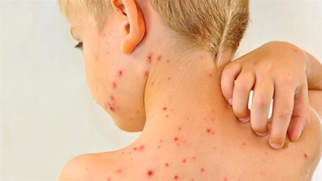 وباء الحصبة يغزو العالم بالانتشار السريع