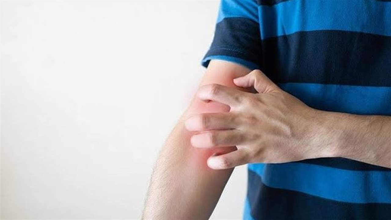 مصادر طبية تحذر من انتشار واسع للجرب في اسطنبول