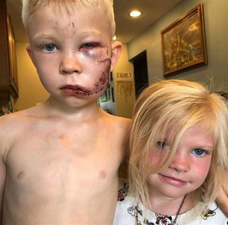 صور: طفلٌ قاتل كلباً شرساً دفاعاً عن شقيقته .. 90 غرزة ولقب عالميّ
