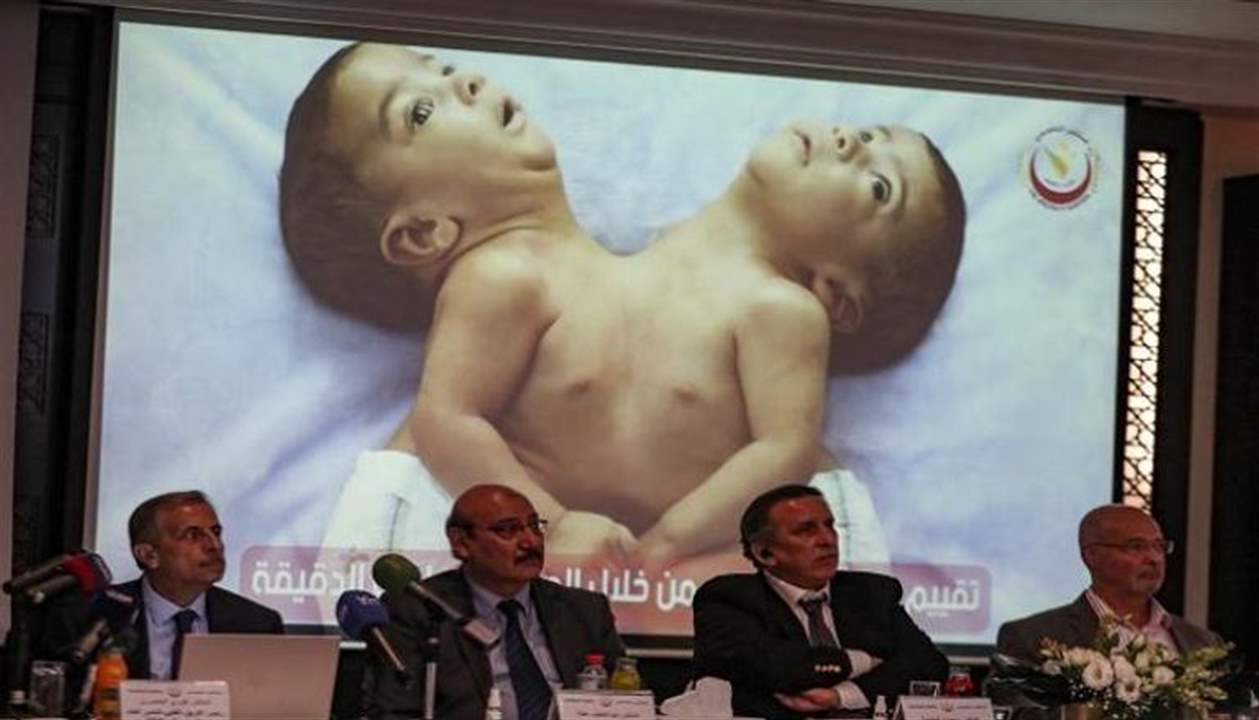 للمرة الأولى في الأردن.. فصل توأم سيامي يمني بعملية "نادرة"