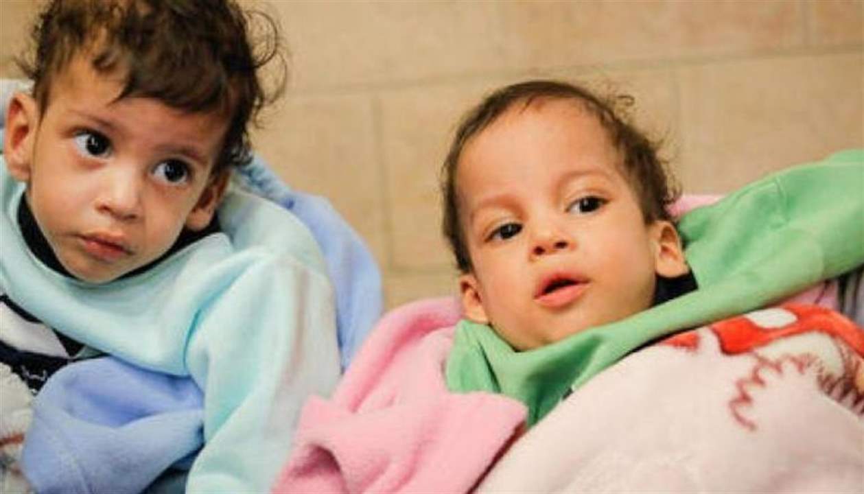 بعد عملية فصل نادرة في الأردن.. توأم يمني سيامي يعود إلى صنعاء