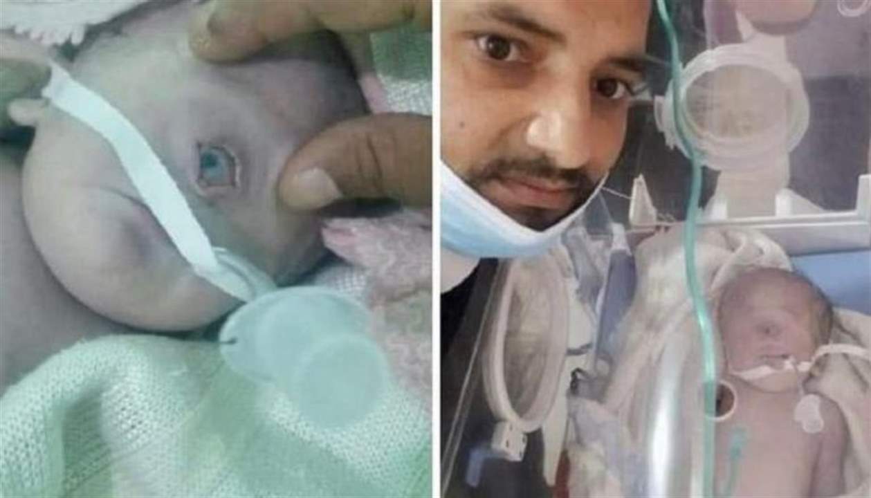 بالصور ـ حالة نادرة أثارت الدهشة .. ولادة طفل بعين واحدة في اليمن