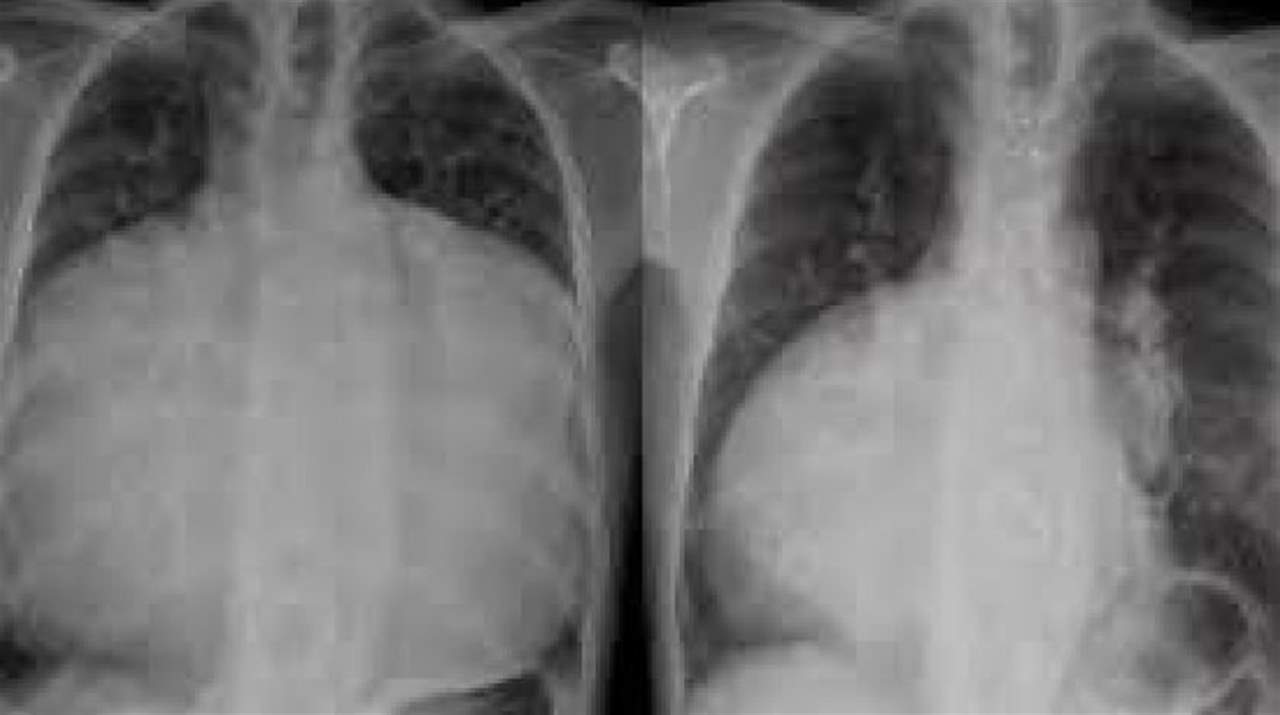 حالة نادرة... قلب رجل يملأ صدره بالكامل !