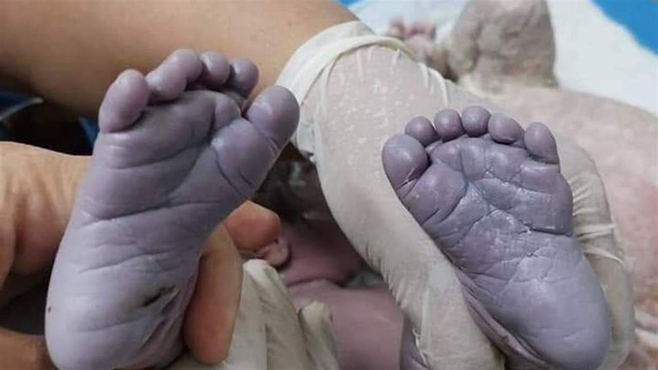 بالصور ـ ولادة طفلة عراقية بصحة جيدة وبـ24 إصبعاً !