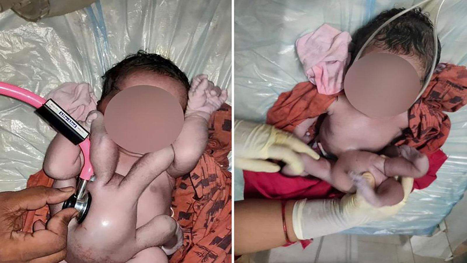  لُقبت بـ"المعجزة".. ولادة طفلة بـ 4 أذرع و4 أرجل في الهند !