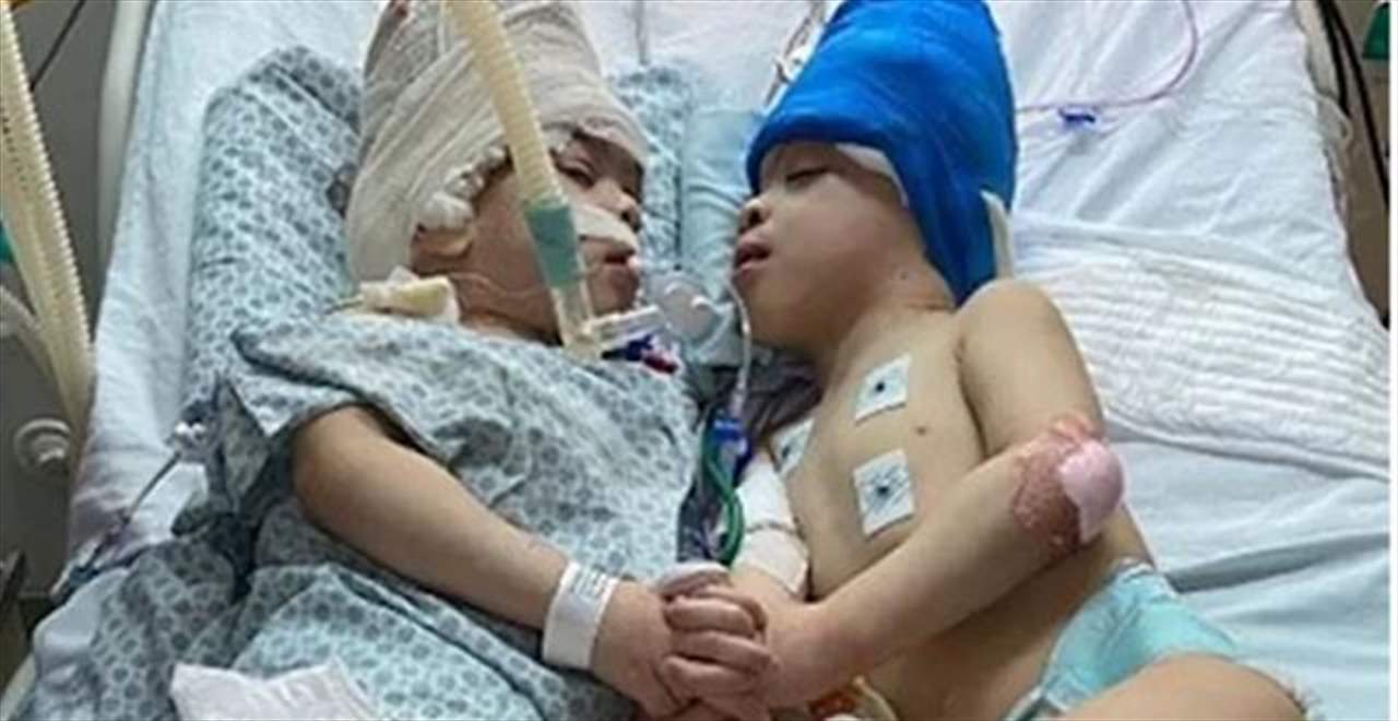 بالفيديو ـ فصل توأمين برازيليين ملتصقي الرأس بمساعدة تقنية الواقع الافتراضي... الجراحة الأكثر تعقيداً في التاريخ !