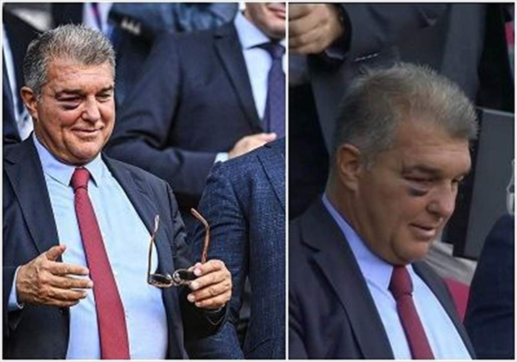 ما سرّ الورم حول عين رئيس برشلونة؟