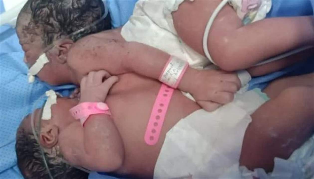 ولادة توأم سيامي "بقلب واحد" في المغرب