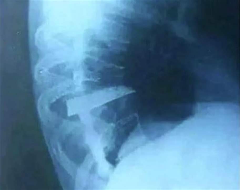  إزالة سكين بقي داخل جسد شاب... والطبيب يكشف تفاصيل العملية