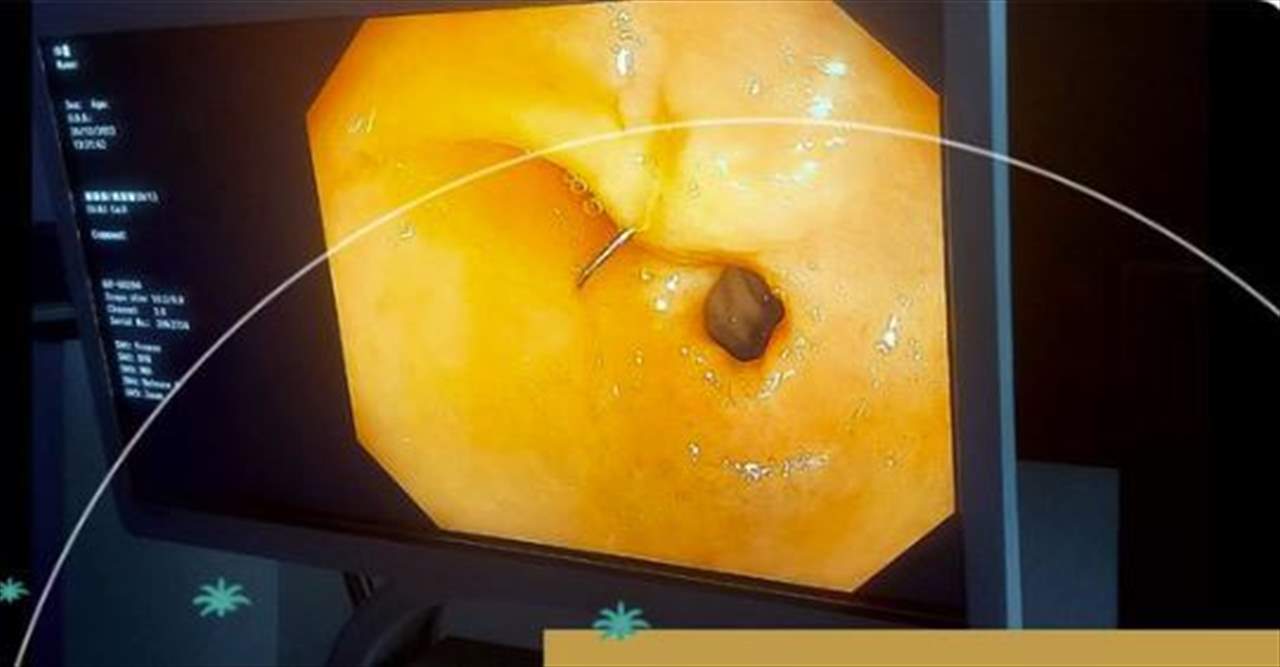 مستشفى ينجح بإزالة إبرة خياطة مغروسة في بطن امرأة!