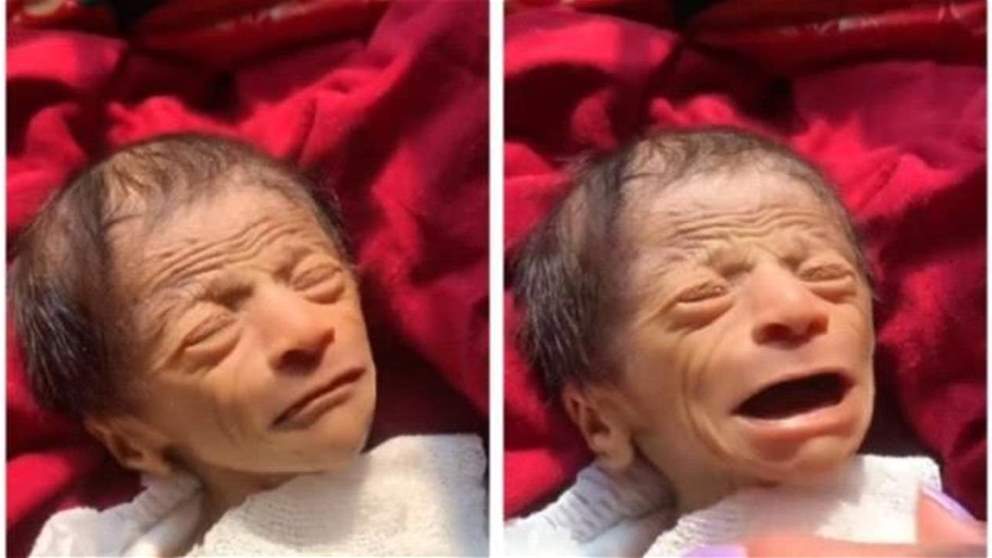 بالفيديو ـ حالة نادرة .. طفل حديث الولادة يتصدر مواقع التواصل بعد ولادته بوجه رجل عجوز !