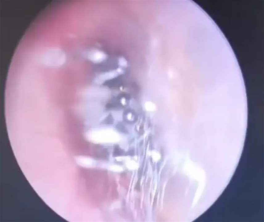 عنكبوت يعيش في أذن مريضة