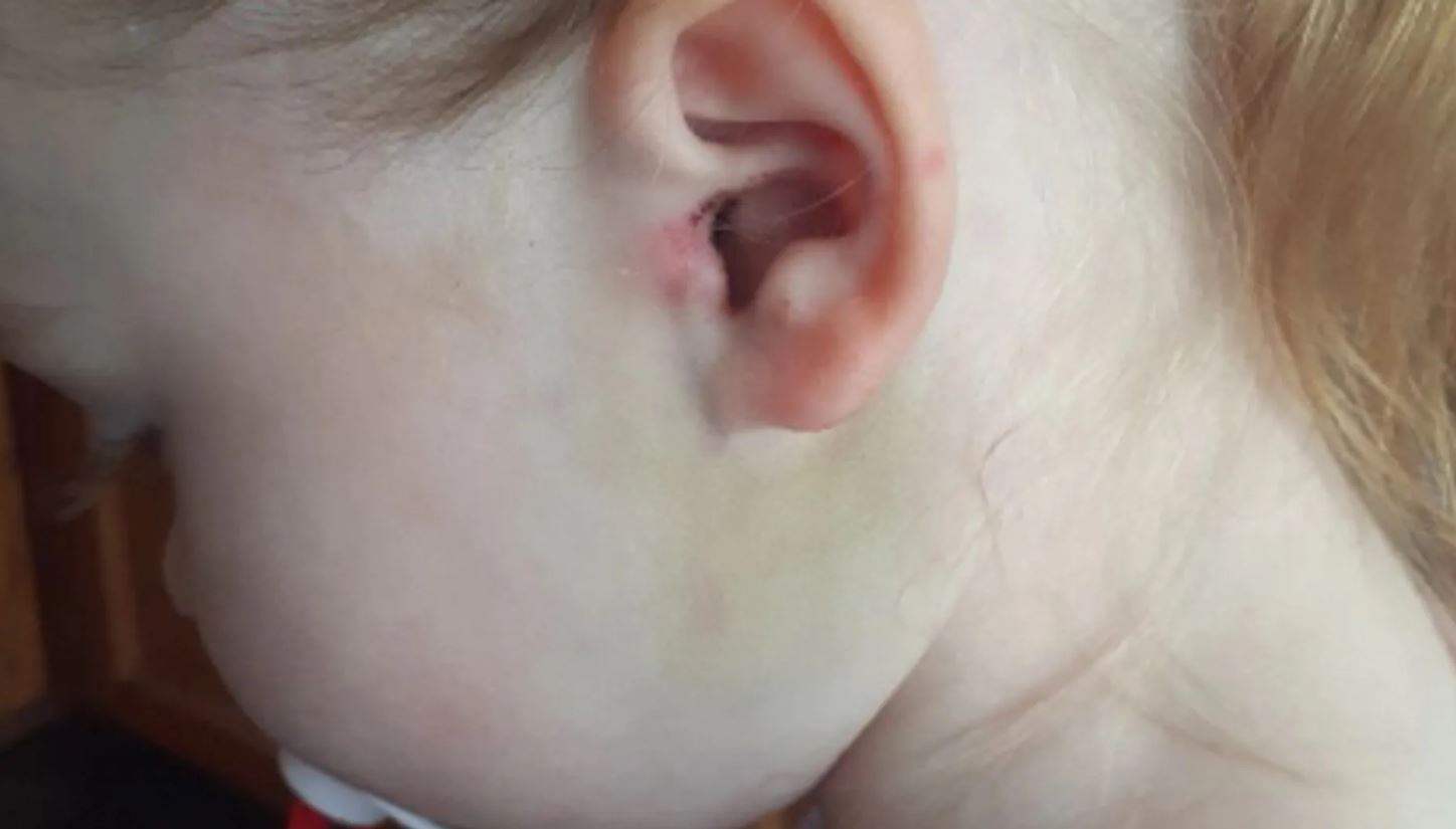 صدمة أم بسبب ما عثرت عليه داخل أذن طفلتها.. وتحذير للآباء