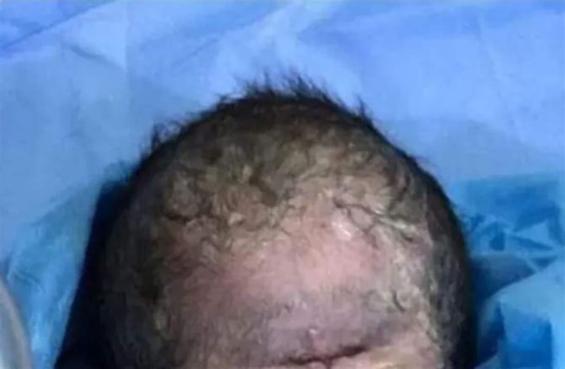 ولادة طفل بعين واحدة والطب يوضح السبب