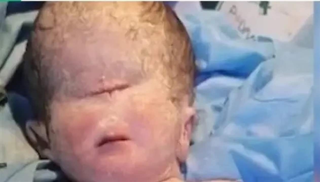 في العراق .. ولادة طفل بعين واحدة والطب يوضح !