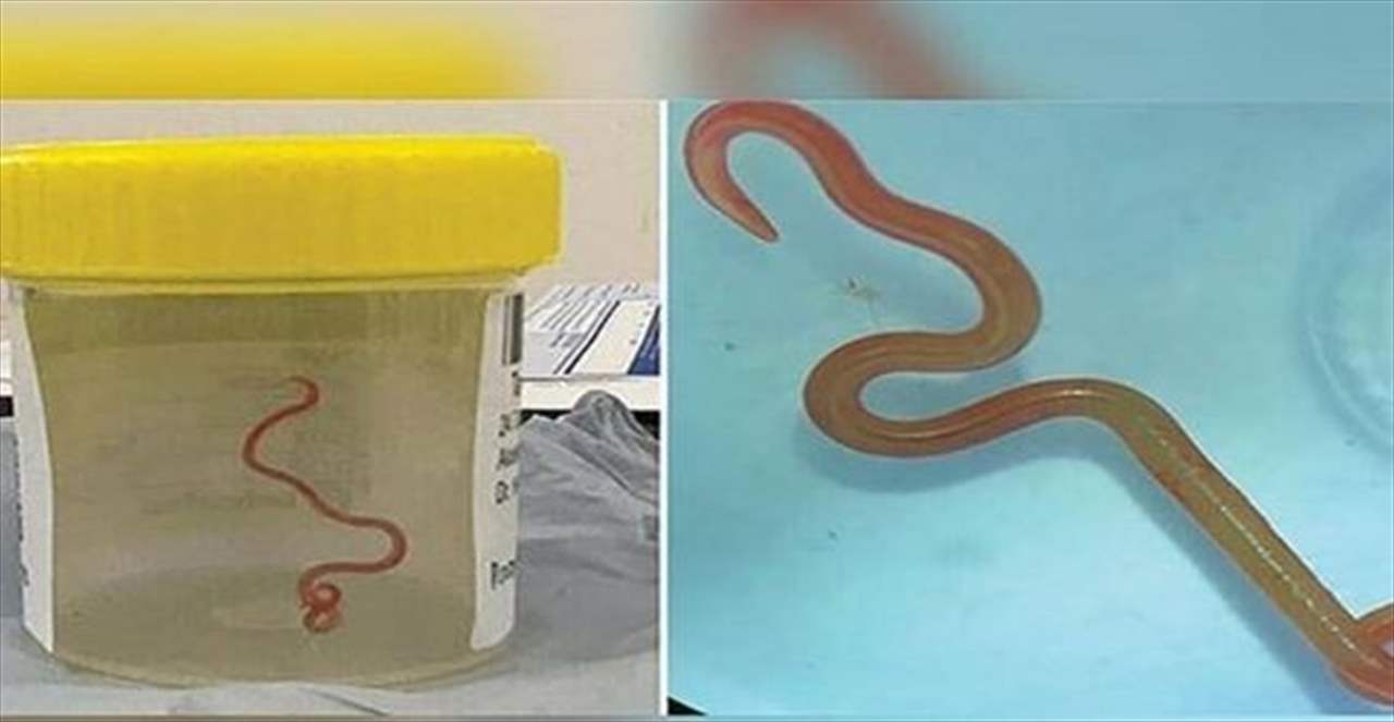 حالة نادرة.. العثور على دودة حية بطول 8 سم في دماغ امرأة!