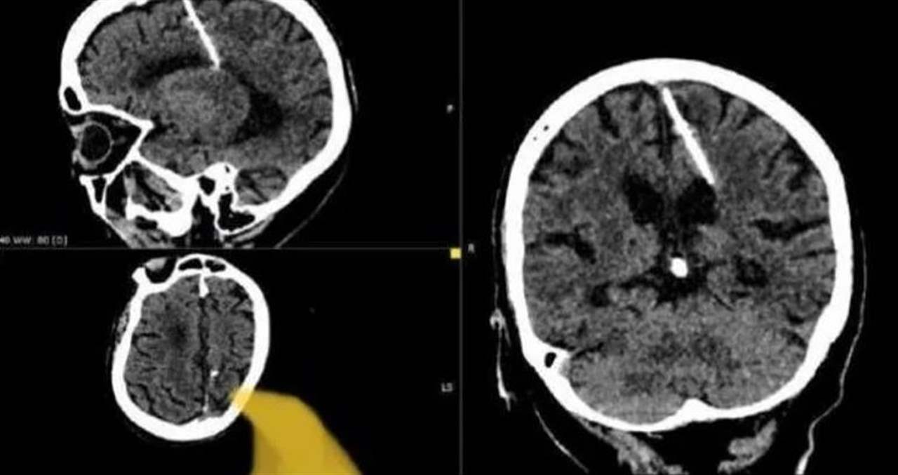 أطباء يعثرون على إبرة في دماغ امرأة منذ 80 عاماً