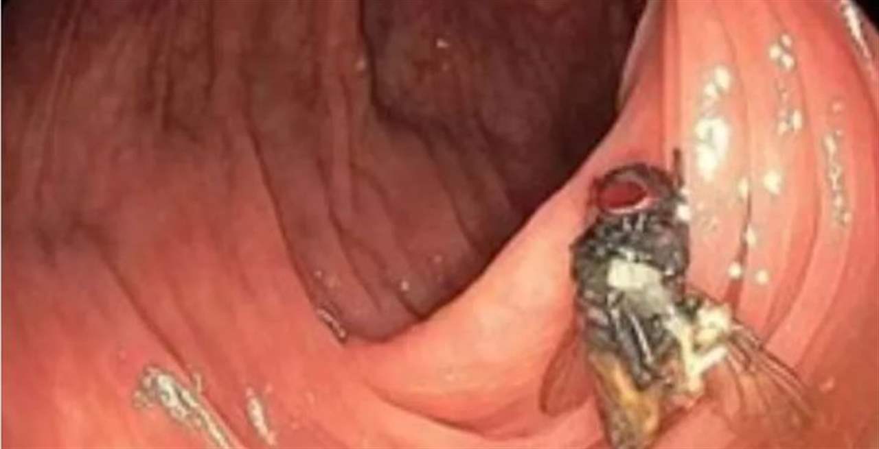 حادثة غريبة تحير الاطباء .. العثور على "ذبابة حية " في أمعاء رجل