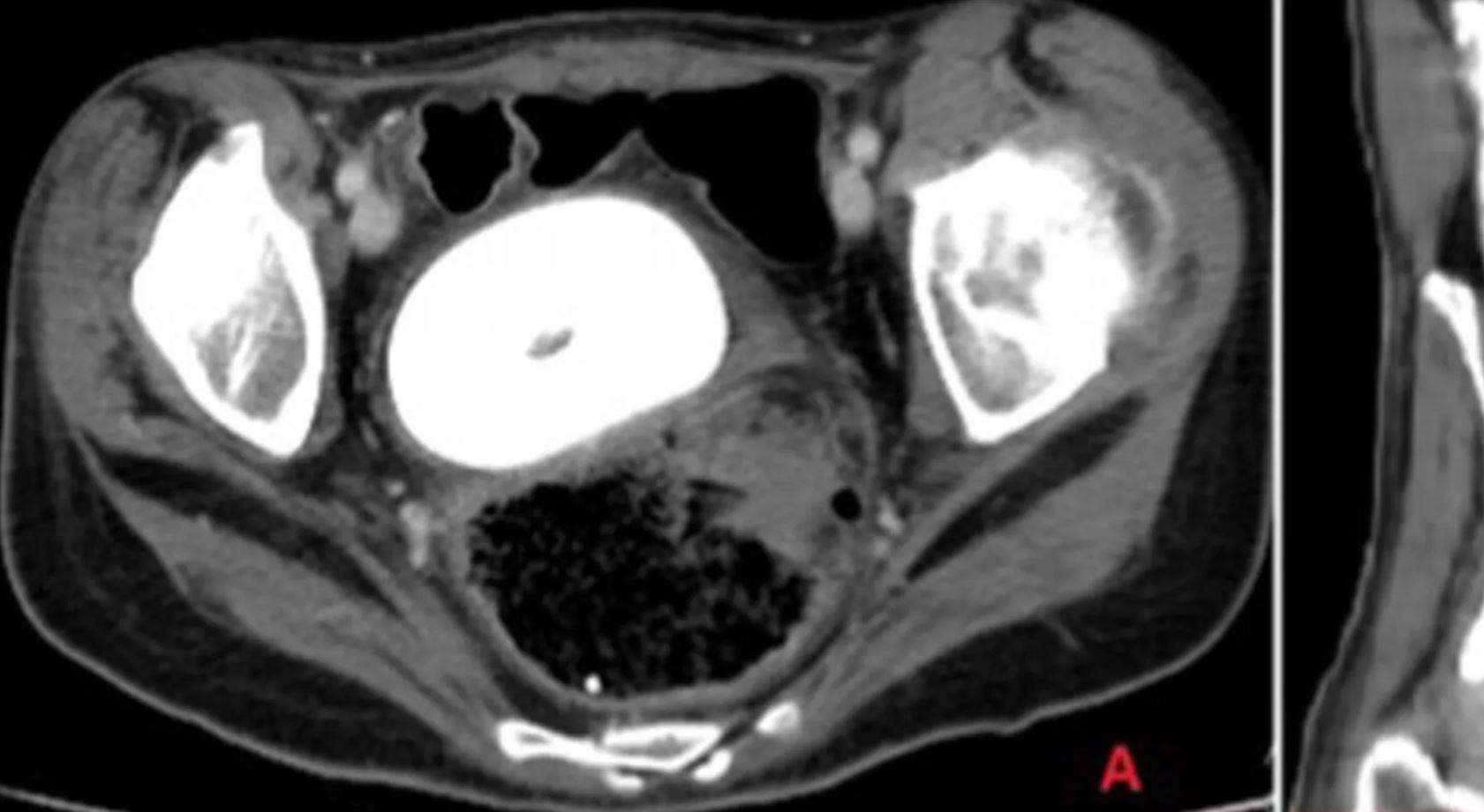 في حالة طبية نادرة.. إكتشاف "حصوة" بحجم برتقالة داخل حوض إمرأة 