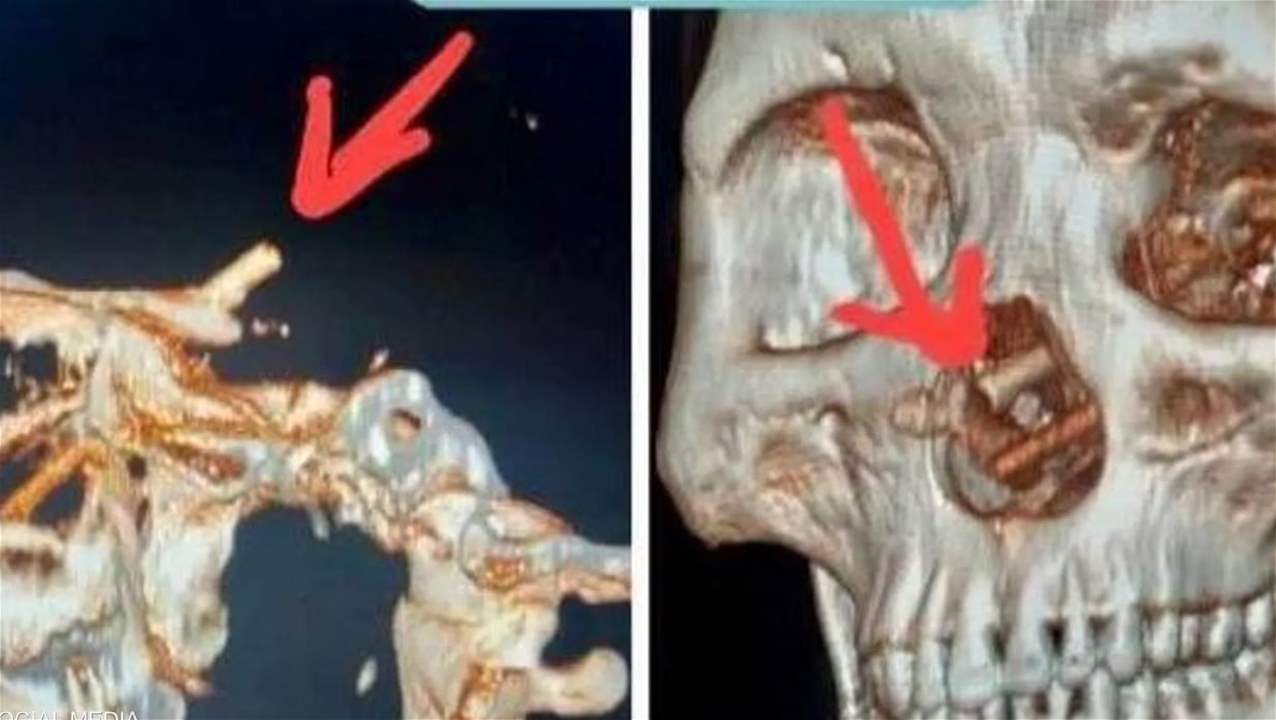 رجل يكتشف "مفاجأة" داخل جمجمته