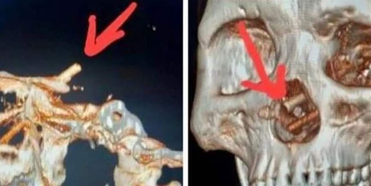  عانى من صداع وفقدان بصر.. وهذا ما اكتشفه داخل جمجمته 