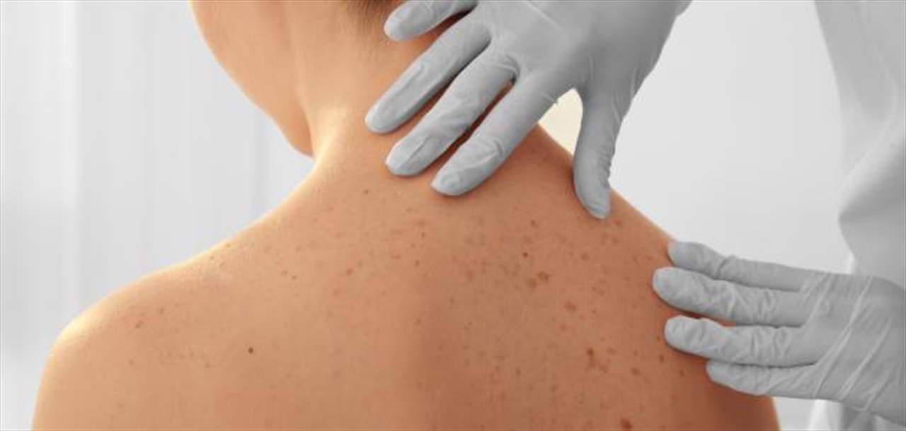 أفضل الطرق لتفادي الإصابة بسرطان الجلد... ماذا في التفاصيل؟ 