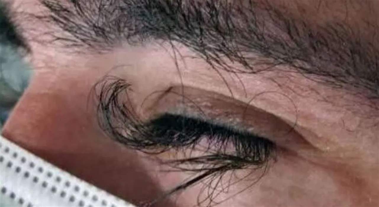 رجل مصاب بالسرطان.. نمت رموشه بطريقة نادرة
