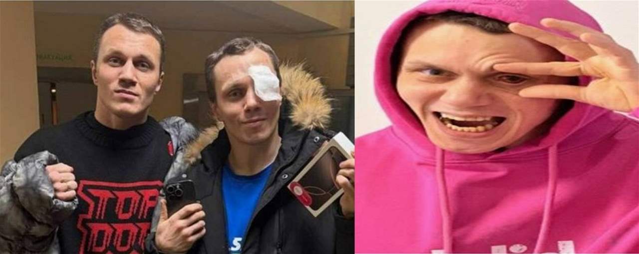 بطل الـ MMA فقد عينه تماماً في عراك مع فتاة