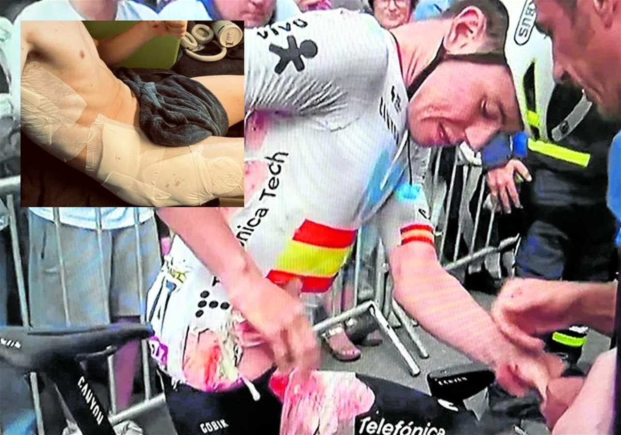 فيديو - الدراج الإسباني إيفان روميو يكشف عن تعرّضه لإصابات مروّعة 