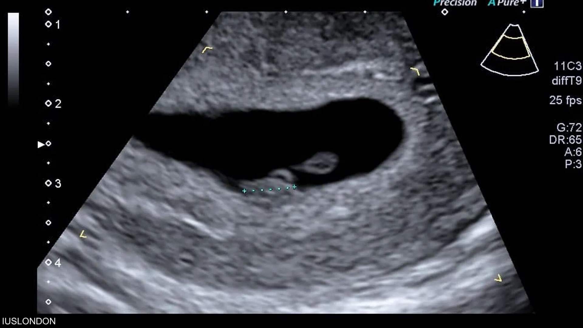 الذكاء الأصطناعي يتنبأ الموعد &quot;الدقيق&quot; للولادة!