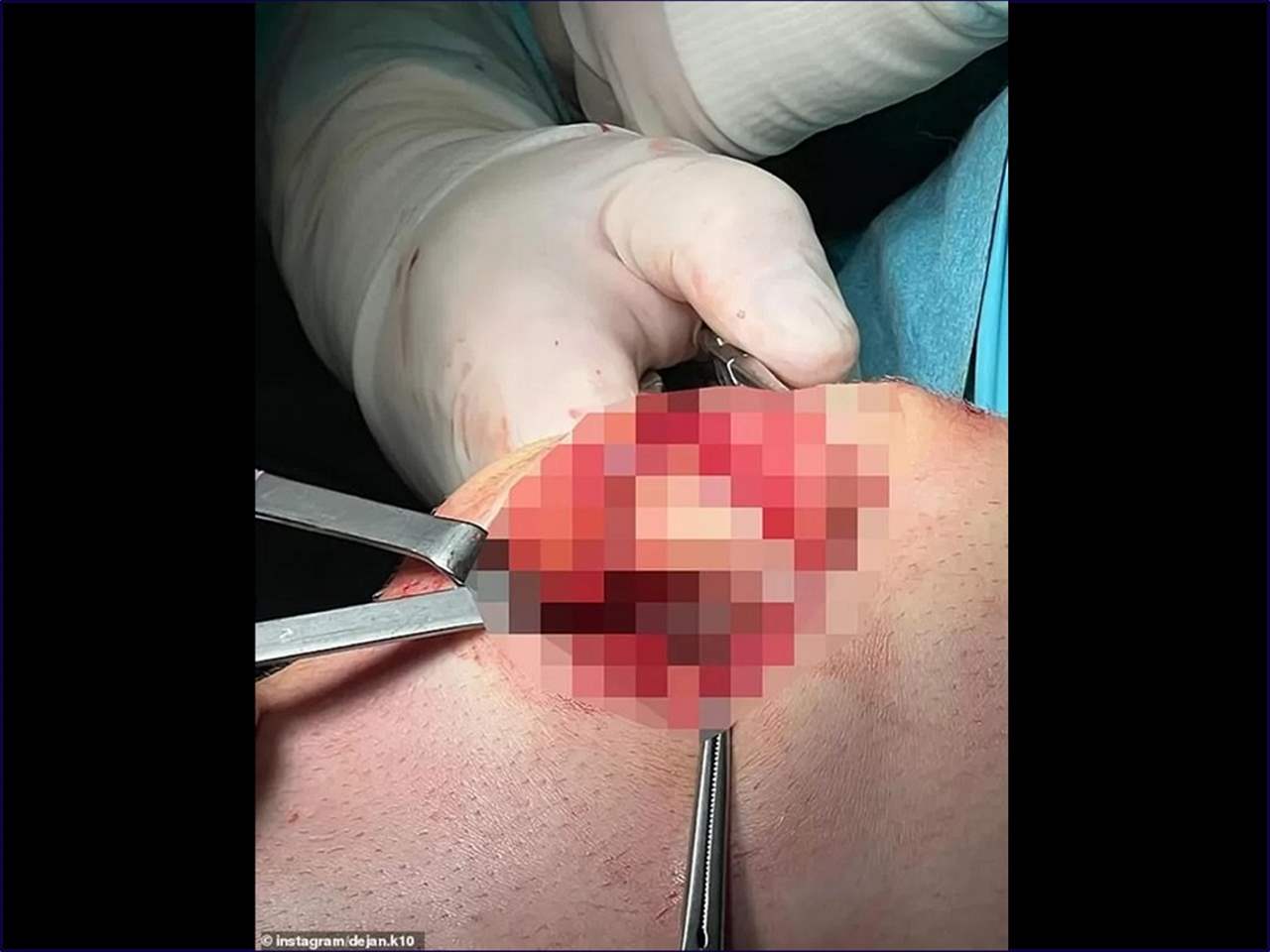 لاعب توتنهام يصدم متابعيه بصورة من جراحة الركبة