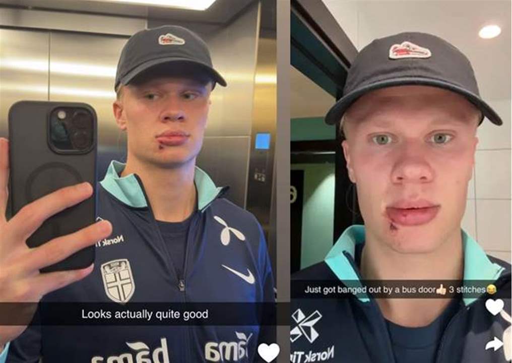 هالاند يتلقى ضربة وثلاث غرز في حافلة المنتخب