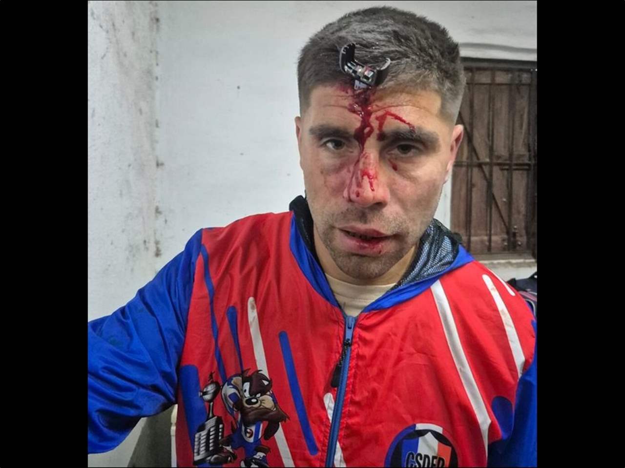 مفتاح السيارة استقر في جبين لاعب كرة قدم