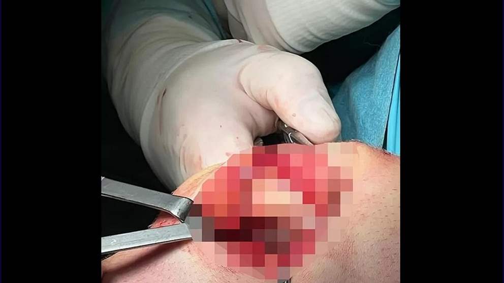 لاعب توتنهام يصدم متابعيه بصورة من جراحة الركبة