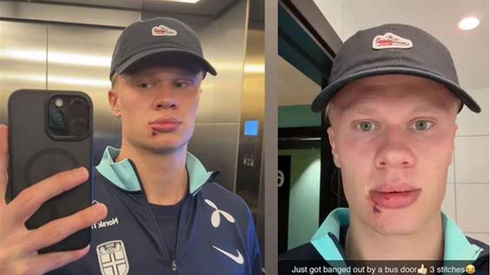 هالاند يتلقى ضربة وثلاث غرز في حافلة المنتخب