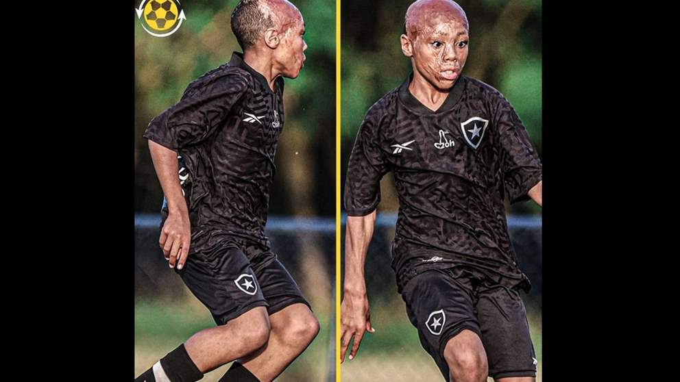 تحدّى المياه المغليّة والحروق وانضم الى بوتافوغو 