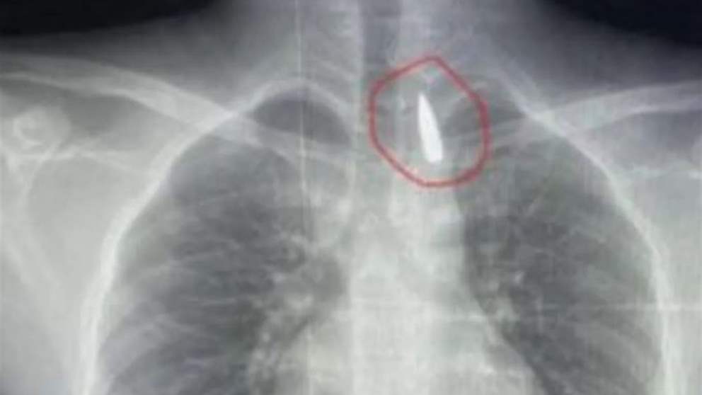 جراحة معقدة.. إنقاذ حياة طفل من غزة مصاب بمقذوف في صدره