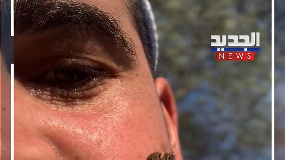 لسعة نحلة.. على الوجه مباشرة! (فيديو)